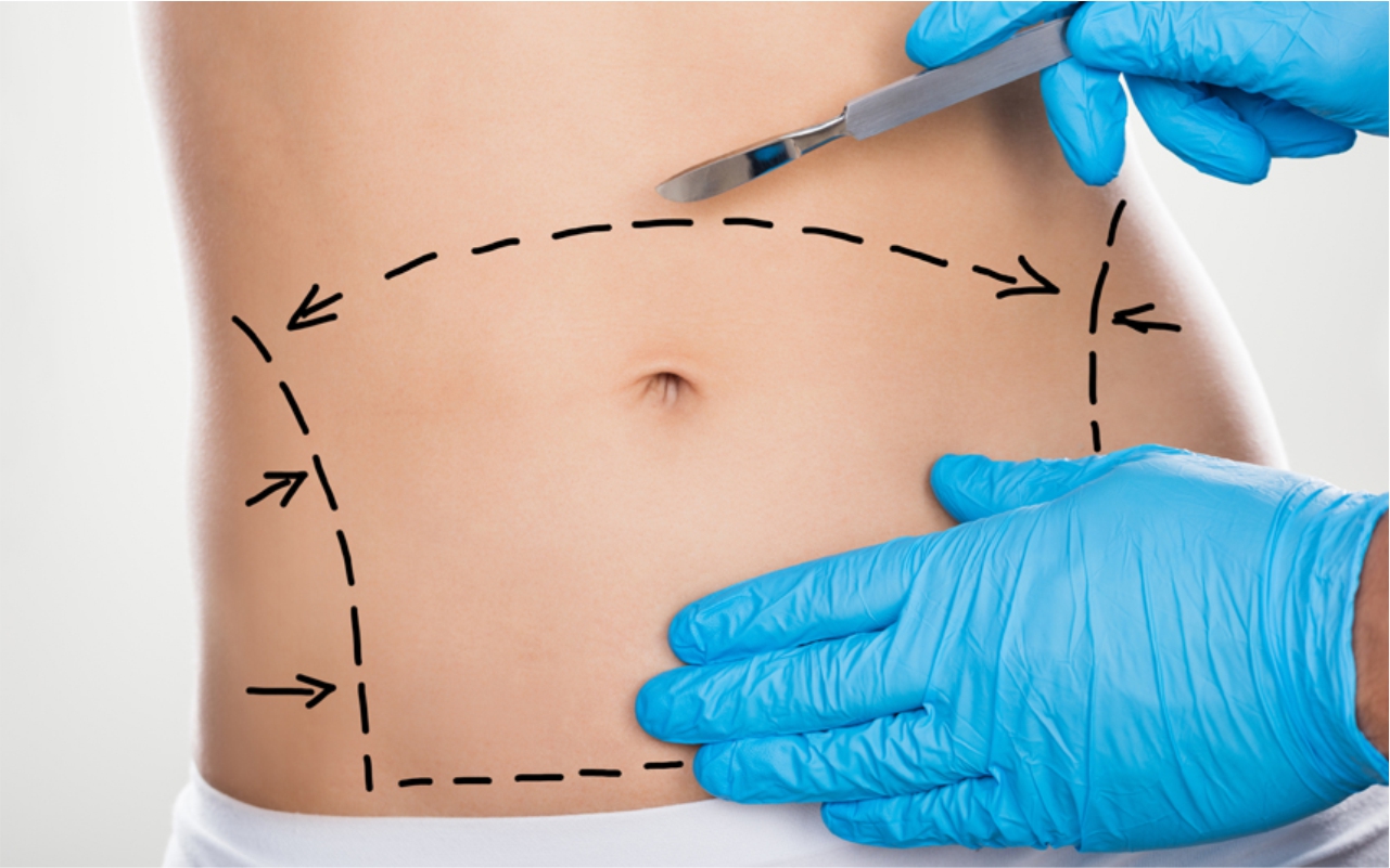 Abdominoplastia | Cirugía Plástica | Clínica Montesur