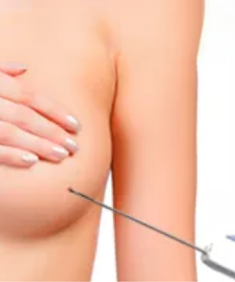 Biopsia percutánea de la mama guiada por ultrasonido